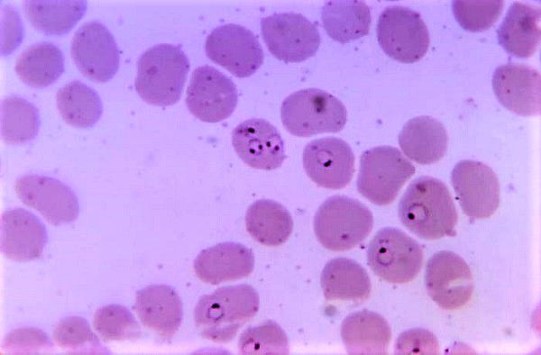 Fundación Recover contribuye a frenar la malaria endémica en Camerún